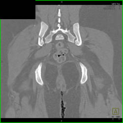 Iliac Wing Fracture and Diastasis of SI Joint - CTisus CT Scan