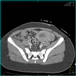 Trauma in Pregnant Patient- See Placenta - CTisus CT Scan