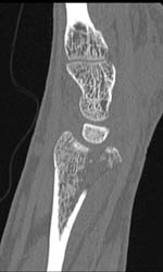 Distal Radius Fracture Into Articular Surface - CTisus CT Scan