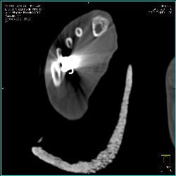 GSW to Foot With Metatarsal Fracture - CTisus CT Scan