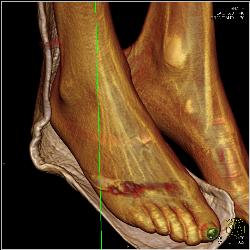 GSW to Foot With Metatarsal Fracture - CTisus CT Scan