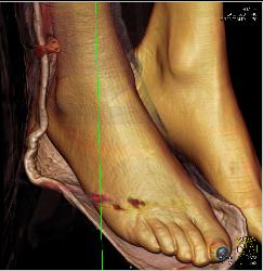 GSW to Foot With Metatarsal Fracture - CTisus CT Scan