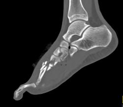 GSW to Foot With Metatarsal Fracture - CTisus CT Scan