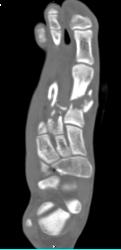 Fracture of First and Second Metatarsals - CTisus CT Scan