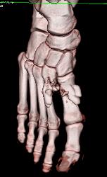 Fracture of First and Second Metatarsals - CTisus CT Scan