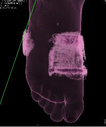 Fracture of First and Second Metatarsals - CTisus CT Scan