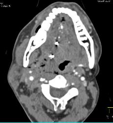 GSW Neck Near Carotid Artery Without Laceration - CTisus CT Scan