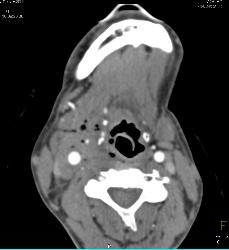 GSW Neck Near Carotid Artery Without Laceration - CTisus CT Scan