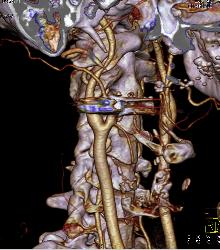 GSW Neck Near Carotid Artery Without Laceration - CTisus CT Scan