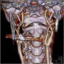 GSW Neck Near Carotid Artery Without Laceration - CTisus CT Scan