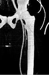 GSW Thigh Without Superficial Femoral Artery (SFA) Injury - CTisus CT Scan