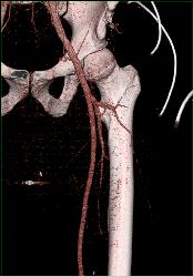 GSW Thigh Without Superficial Femoral Artery (SFA) Injury - CTisus CT Scan