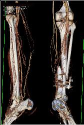 Complex Fracture Without Vascular Injury - CTisus CT Scan