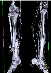 Complex Fracture Without Vascular Injury - CTisus CT Scan