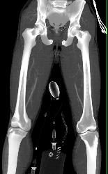 Complex Fracture Without Vascular Injury - CTisus CT Scan