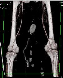 Complex Fracture Without Vascular Injury - CTisus CT Scan