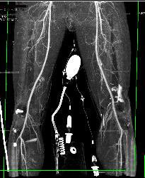 Complex Fracture Without Vascular Injury - CTisus CT Scan