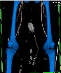 Complex Fracture Without Vascular Injury - CTisus CT Scan