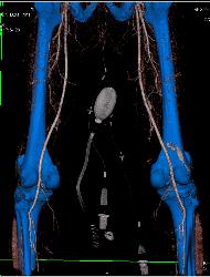 Complex Fracture Without Vascular Injury - CTisus CT Scan