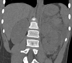 Renal Laceration and Bleed - CTisus CT Scan