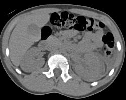 Renal Laceration and Bleed - CTisus CT Scan