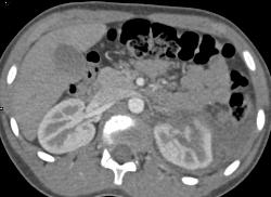 Renal Laceration and Bleed - CTisus CT Scan