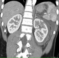 Renal Laceration and Bleed - CTisus CT Scan