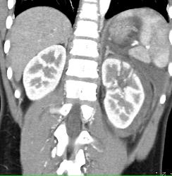 Renal Laceration and Bleed - CTisus CT Scan