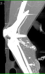 GSW to Knee With Bleed From Popliteal Artery - CTisus CT Scan