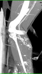 GSW to Knee With Bleed From Popliteal Artery - CTisus CT Scan