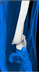 Complex Fracture of Distal Tibial/fibula With 3D Bone Editing - CTisus CT Scan