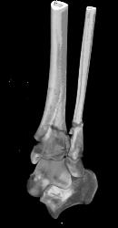 Complex Fracture of Distal Tibial/fibula With 3D Bone Editing - CTisus CT Scan