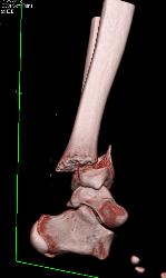 Complex Fracture of Distal Tibial/fibula With 3D Bone Editing - CTisus CT Scan