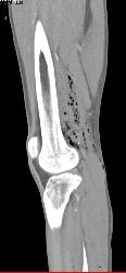 GSW Knee With Spasm Distal Superficial Femoral Artery (SFA) Without Bleed - CTisus CT Scan