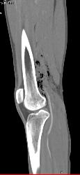 GSW Knee With Spasm Distal Superficial Femoral Artery (SFA) Without Bleed - CTisus CT Scan