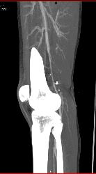 GSW Knee With Spasm Distal Superficial Femoral Artery (SFA) Without Bleed - CTisus CT Scan