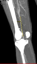 GSW Knee With Spasm Distal Superficial Femoral Artery (SFA) Without Bleed - CTisus CT Scan