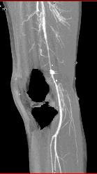 GSW Knee With Spasm Distal Superficial Femoral Artery (SFA) Without Bleed - CTisus CT Scan