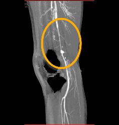 GSW Knee With Spasm Distal Superficial Femoral Artery (SFA) Without Bleed - CTisus CT Scan