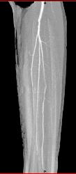 GSW Knee With Spasm Distal Superficial Femoral Artery (SFA) Without Bleed - CTisus CT Scan