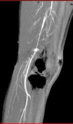 GSW Knee With Spasm Distal Superficial Femoral Artery (SFA) Without Bleed - CTisus CT Scan