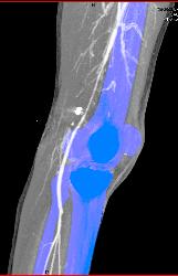 GSW Knee With Spasm Distal Superficial Femoral Artery (SFA) Without Bleed - CTisus CT Scan