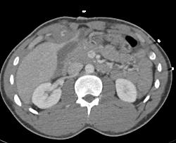 Liver Laceration and Bleed - CTisus CT Scan