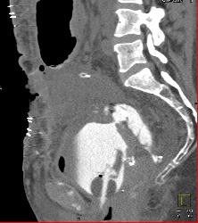 Perforated Bladder With Leak on CT Cystogram - CTisus CT Scan