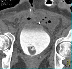 Perforated Bladder With Leak on CT Cystogram - CTisus CT Scan