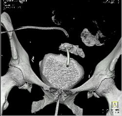 Perforated Bladder With Leak on CT Cystogram - CTisus CT Scan