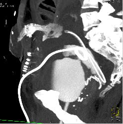 Perforated Bladder With Leak on CT Cystogram - CTisus CT Scan