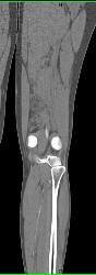 GSW Knee With Vascular Injury - CTisus CT Scan