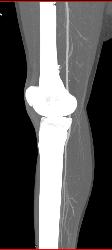 GSW Knee With Vascular Injury - CTisus CT Scan