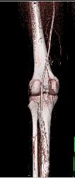 GSW Knee With Vascular Injury - CTisus CT Scan